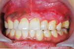 歯肉メラニン除去　症例1