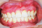 歯肉メラニン除去　症例1