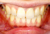 審美歯科　症例1