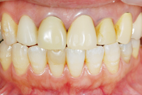 審美歯科　症例2