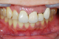 審美歯科　症例3