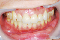 審美歯科　症例3
