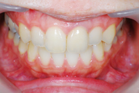 審美歯科　症例4