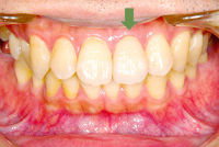 審美歯科　症例5
