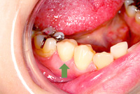 審美歯科　症例6