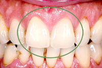 審美歯科　症例7